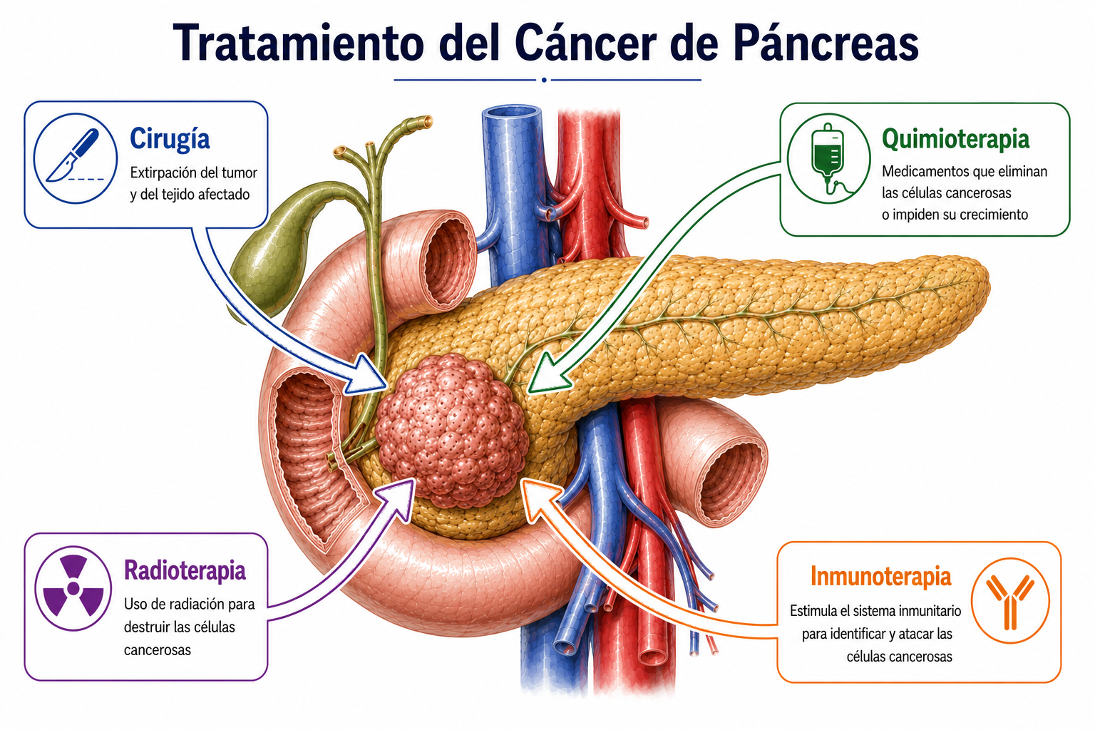 Síntomas de cáncer de páncreas